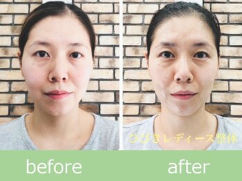 ひびきレディース整体 日吉/印象が激変!花嫁フェイスライン