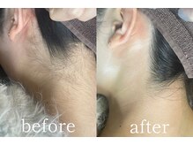 ムート(Mut.)/うなじワックス＋光脱毛。