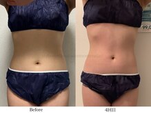 スラリ(SLARI)/【腹部　脂肪冷却】期間2か月