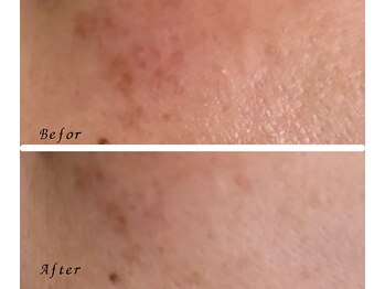 アイリーボーテ 東大阪(アイリーBEAUTE)/ビタミンC/A導入