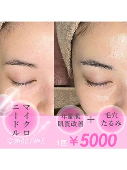 スムース イー(Smooth+E)の写真/プリっとハリのある肌に☆マイクロニードル＆ポレーションで年齢肌くすみたるみもピンと張ったお肌に改善◎