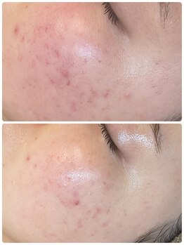 ヴェールココン(Veil Cocon)/碧ハーブ+酸ピーリング