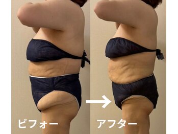 ドクターエイジレス(DR.AGELESS)/1部位集中脂肪取りメニューも!