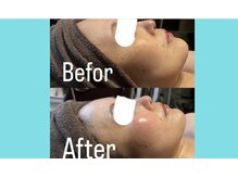 アヌヘア(Anuhea)/プラズマ×ハーブピーリング