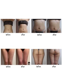 クーラ テュセ(Coeur la Tusais)/全身まるごと7種脂肪撃退★