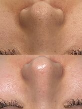 韓国肌管理室ハナ(hana)/肌質改善/毛穴洗浄/毛穴洗浄大阪