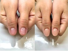 アーティネイルズ(Aaty Nails)/【深爪矯正】ハンド