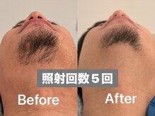 ラトリエ(L'Atelier)/ヒゲ脱毛5回 ビフォー/アフター