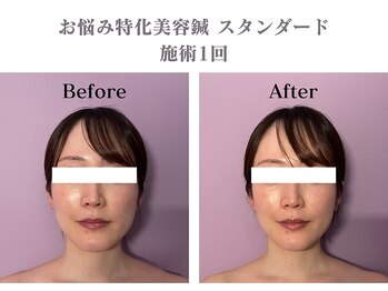 シー バイ カリスタ 渋谷店(C by CALISTA)/美容鍼60分 施術効果