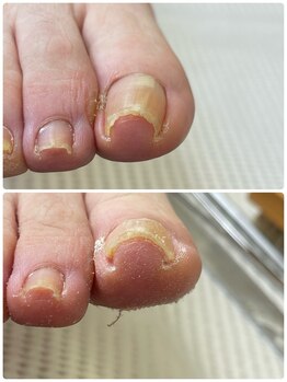 巻き爪じゅん 船橋店/丁寧なケアで快適歩行を取り戻す