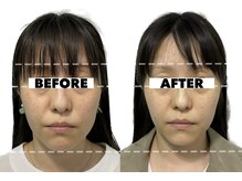 カドモリ 心斎橋(KADOMORI)/小顔矯正×美容鍼3回【美容鍼】