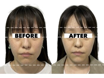 カドモリ 心斎橋(KADOMORI)/小顔矯正×美容鍼3回【美容鍼】