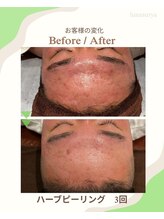 ルナスーリヤ 仙台店/ハーブピーリング