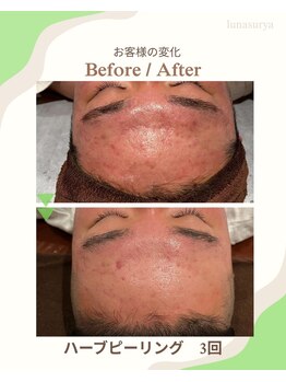 ルナスーリヤ 仙台店/ハーブピーリング