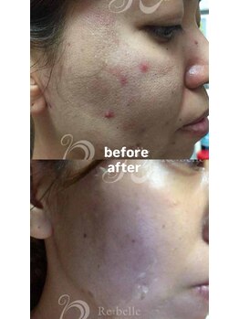 セレネ(SELENE)/頬のニキビ、赤ニキビ