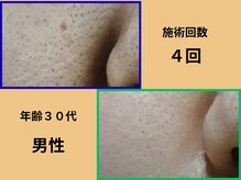 美肌の間 樟/バクテリウムピールリボーニング