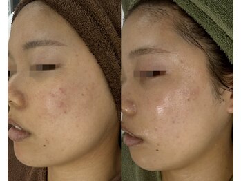 肌質改善専門【Salon da Mahina】毛穴ケア/ニキビケア/ハーブピーリング/ニキビ/毛穴/ハーブピーリング