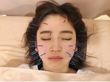 こじま 富雄団地接骨院/美容鍼