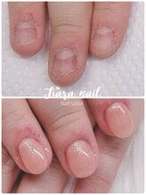 ティアラネイル 宇都宮/リプロネイル深爪矯正コース