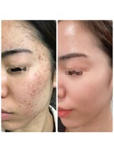 リボディ プラチナ(Rebody platinum)/プラズマ/プラズマシャイニー