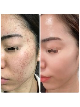 リボディ プラチナ(Rebody platinum)/プラズマ/プラズマシャイニー