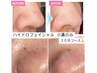 小鼻のみの時短コース！気になるとこだけ速攻ケア♪¥4500→¥3800今だけお得！