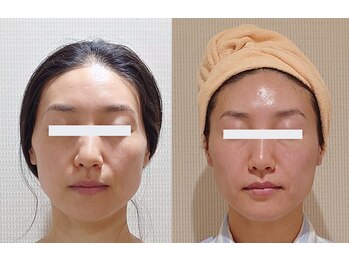 アルマ 芦屋(ALMA)/リジュケアヘッド+小顔矯正5分!