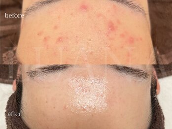 ルアナ(LUANA)/繰り返す肌荒れに！