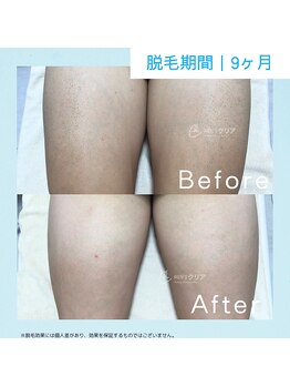 メンズクリア アスピア明石店/【メンズクリア】お客様の施術例