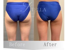 ステラ(STELLA)/下半身プレミアムの効果