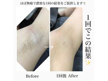 ハダハダ(HADA HADA Medical Esthetic)の雰囲気(気になるワキの黒ずみも綺麗に♪)