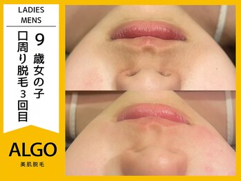 アルゴ 小松店(ALGO)/お子様の口周り脱毛