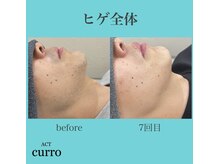 アクト クロ(ACT curro)/【ヒゲ全体】脱毛施術例