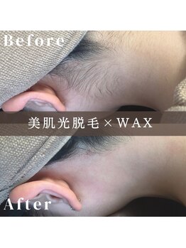 エピナ 横浜店(Epina)/うなじ脱毛/ブライダル脱毛