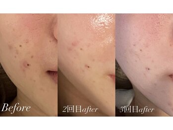 ベルバーチュプラス(Belle Virtue +)/カーボキシー＋エピダームパック