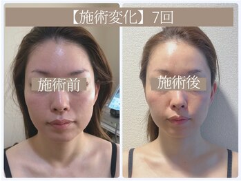 ドクターボディ 恵比寿店(Dr.Body)/【頬骨出っ張り/人中縮小 30代】