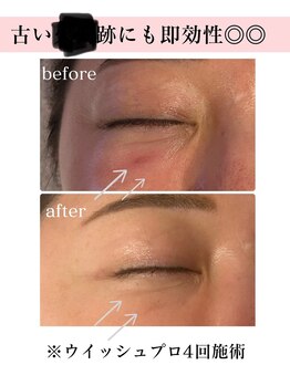 ウィッシュプロサロンケー(WISHpro salon K)/キズ跡にもウイッシュプロ！