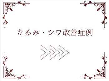 ロイヤル(ROYAL)/たるみ・しわ改善症例