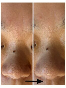 サロン リノ(salon rino)の写真/満たして、浮かせて、洗い流す！黒ずみ、角栓ごっそり毛穴リセット◎ 毛穴悩み、一度リセットしませんか？