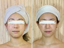 マキシフォート 名駅店(Maxifort)/小顔コルギ体験レポート