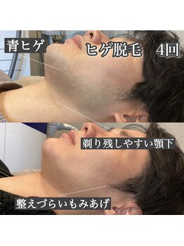 プリマプリート 大垣店/メンズ・・ヒゲ脱毛