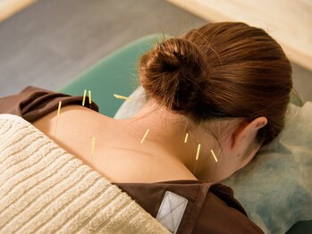 キート美容鍼灸 整体院(Kiito美容鍼灸 整体院)/全身の鍼～肩～