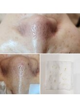 アナシアビューティーサロン(Anacia)/全顔毛穴エクストラクション