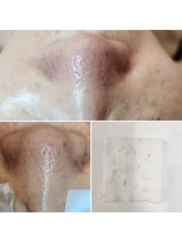 アナシアビューティーサロン(Anacia)/全顔毛穴エクストラクション