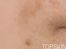 トップスキン 栄(TOPSKIN)/シミもハーブピーリングで撃退♪