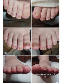 アンティ(Aunty)/爪がくいこむ人差し指の爪