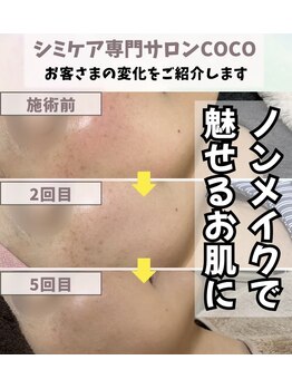 ココ(COCO)/シミケア、ビフォー、アフター