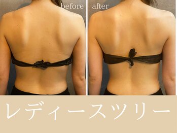 チャームズ(CHARM'S)/パワーツリー背中の変化★