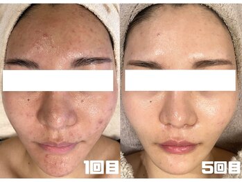 モーヴ 藤沢(MAUVE)/ハーブピーリング