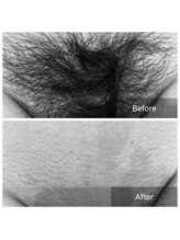 アート 熊本並木坂店(ART)/vio/ブラジリアンワックス脱毛